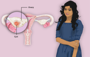 Ovarian-cyst