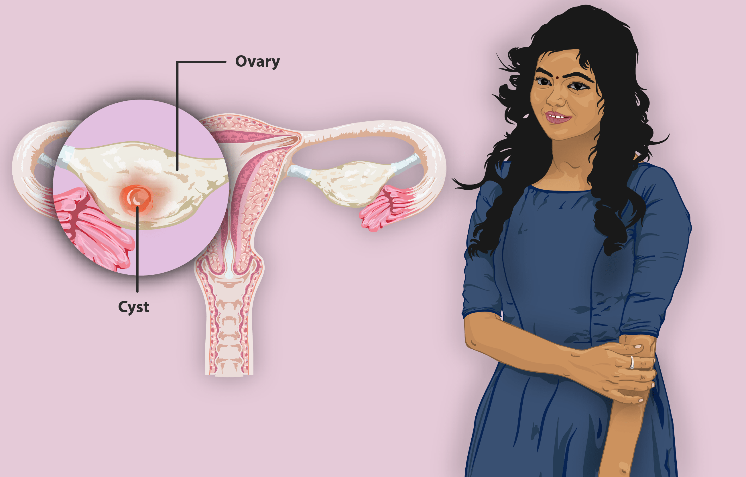 Ovarian-cyst