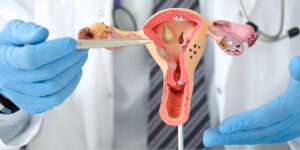 Ovarian-Cysts