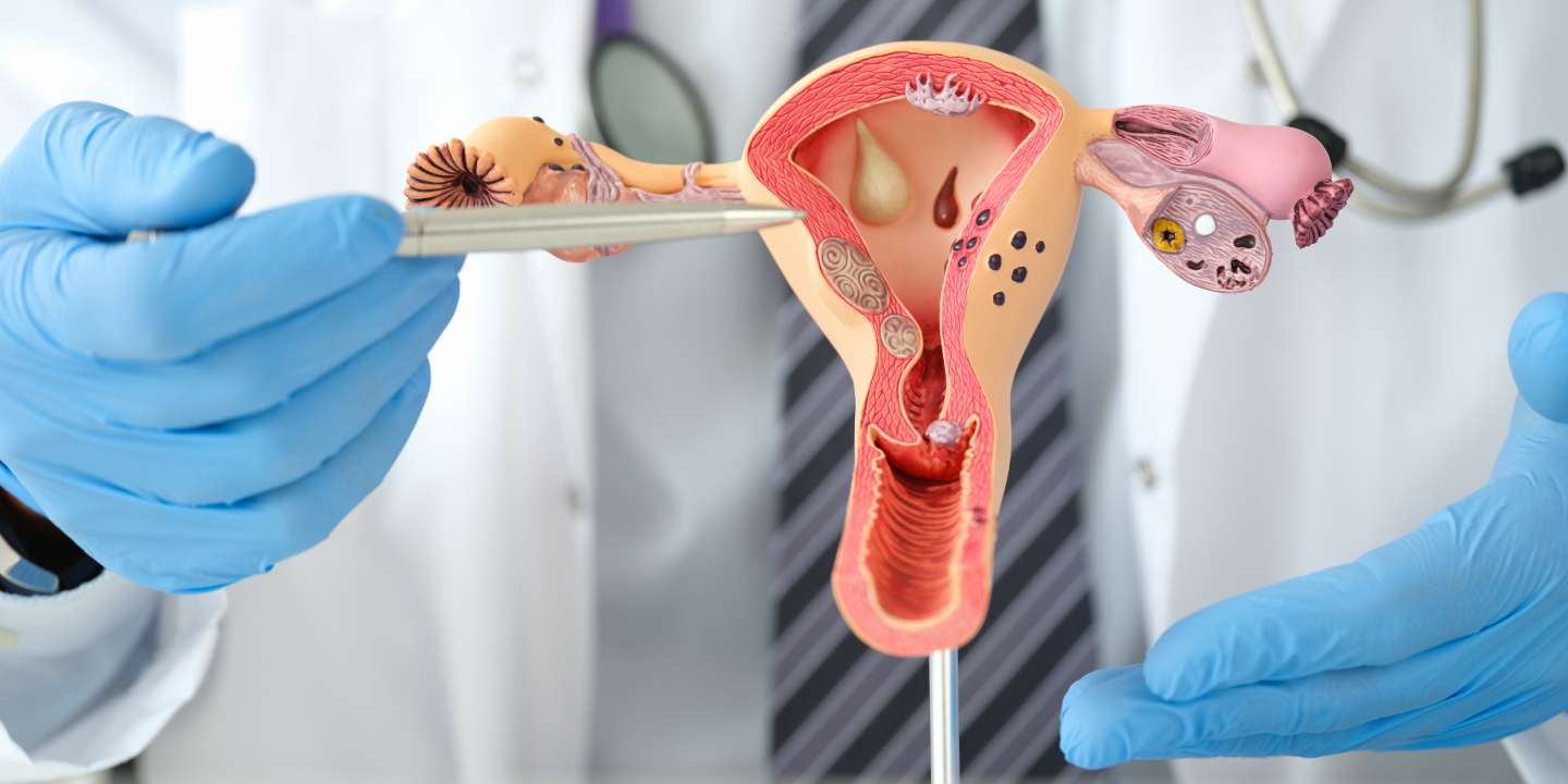 Ovarian-Cysts