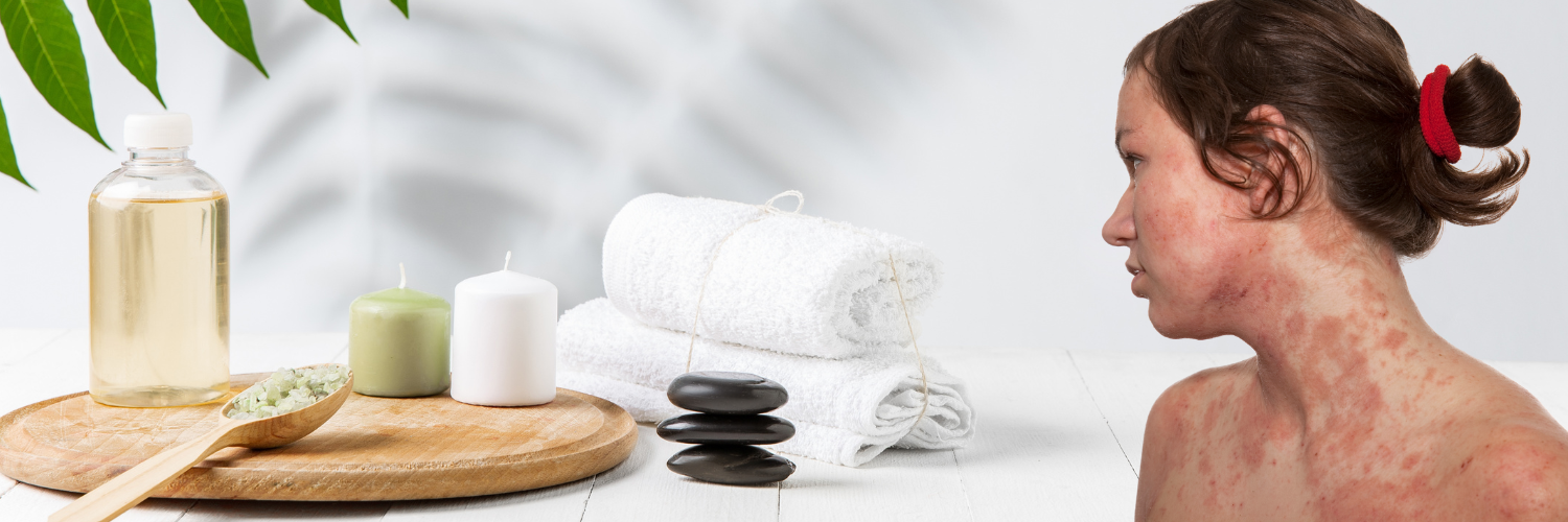 Ayurvedic Psoriasis Treatment