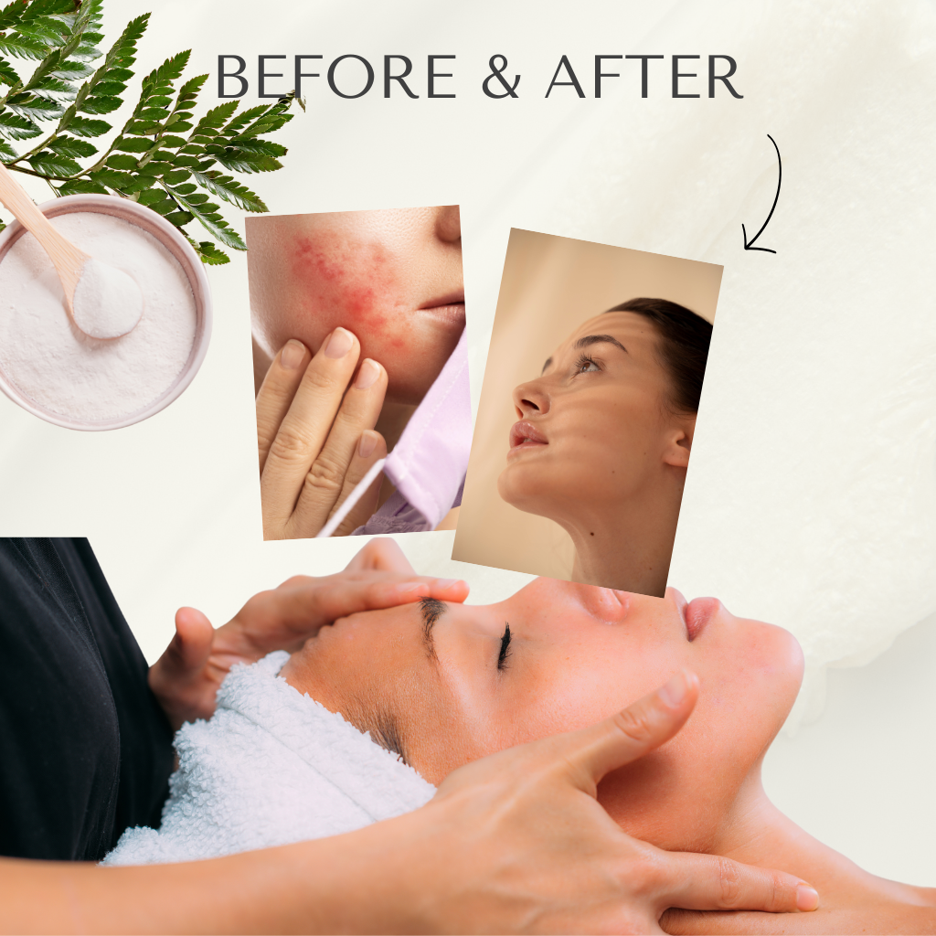 Best Rosacea Treatment in Noida