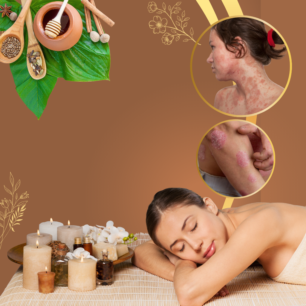 Ayurvedic Psoriasis Treatment in Noida