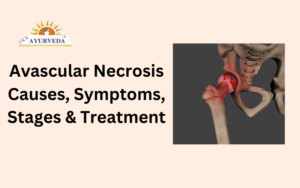 avascular necrosis