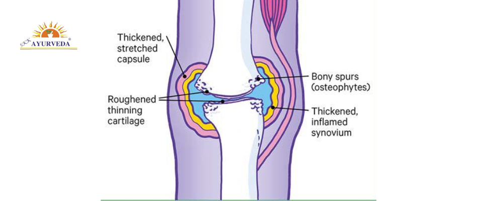 arthritis