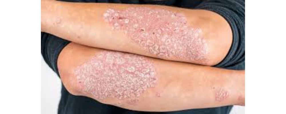 psoriasis