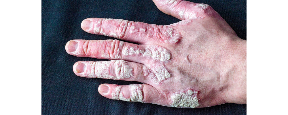 psoriasis