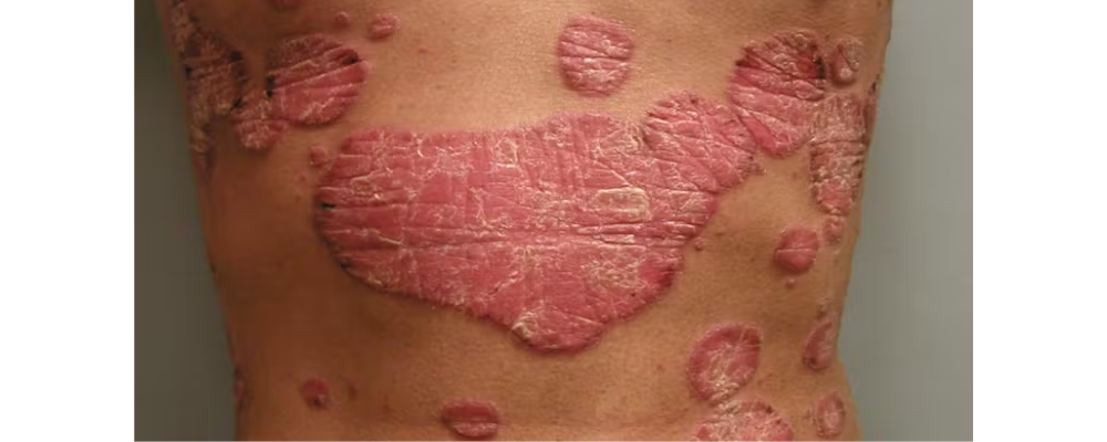 psoriasis