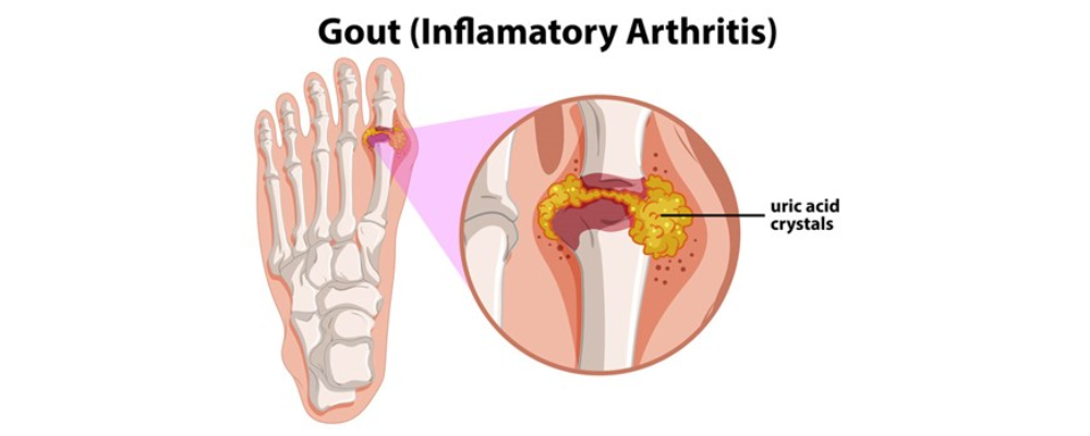 arthritis