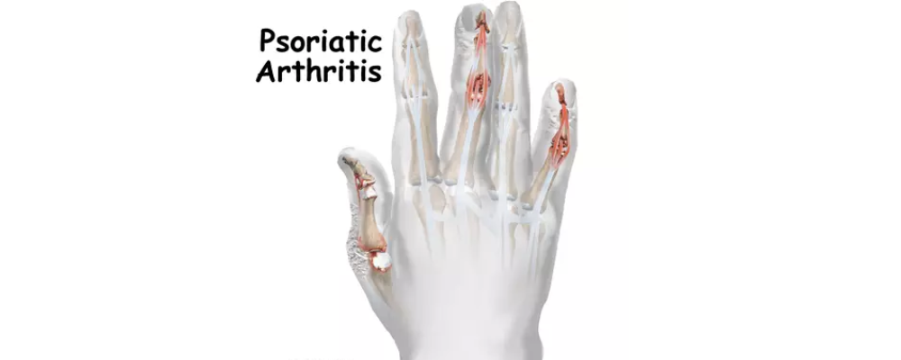 arthritis