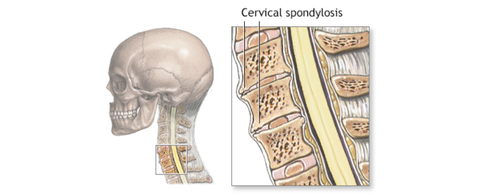 cervical spondylosis