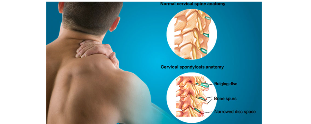 Cervical Spondylosis
