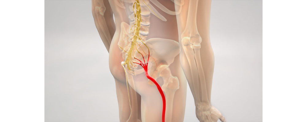 sciatica