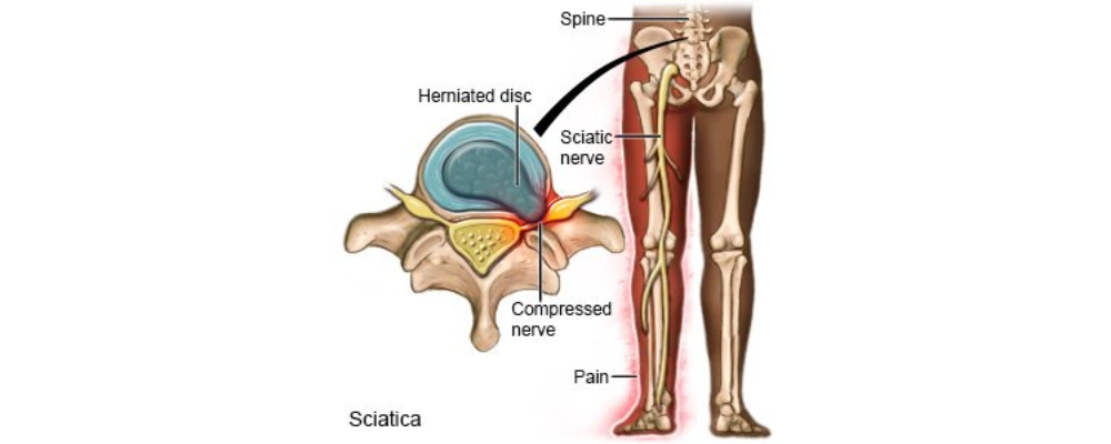 sciatica