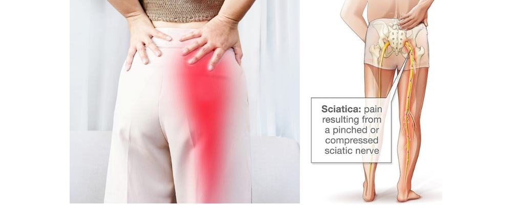 sciatica