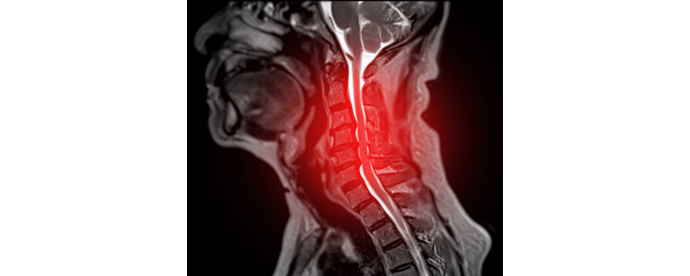 cervical spondylosis