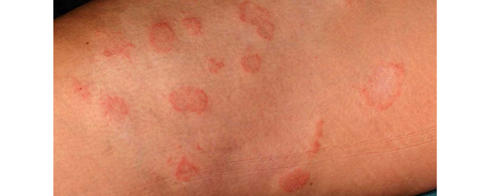 fungal infection