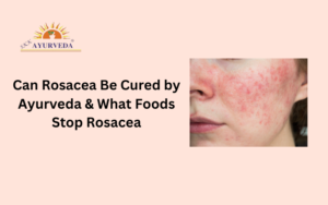 Rosacea