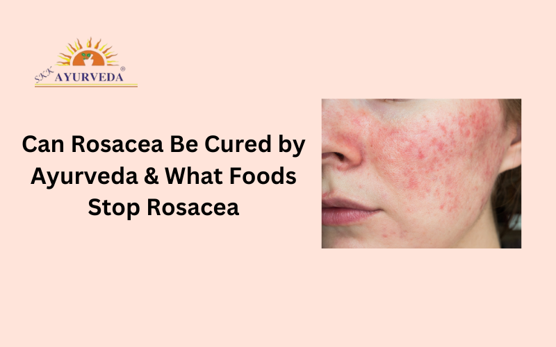 Rosacea