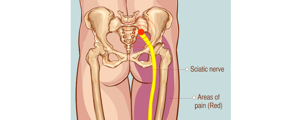 Sciatica Treatment