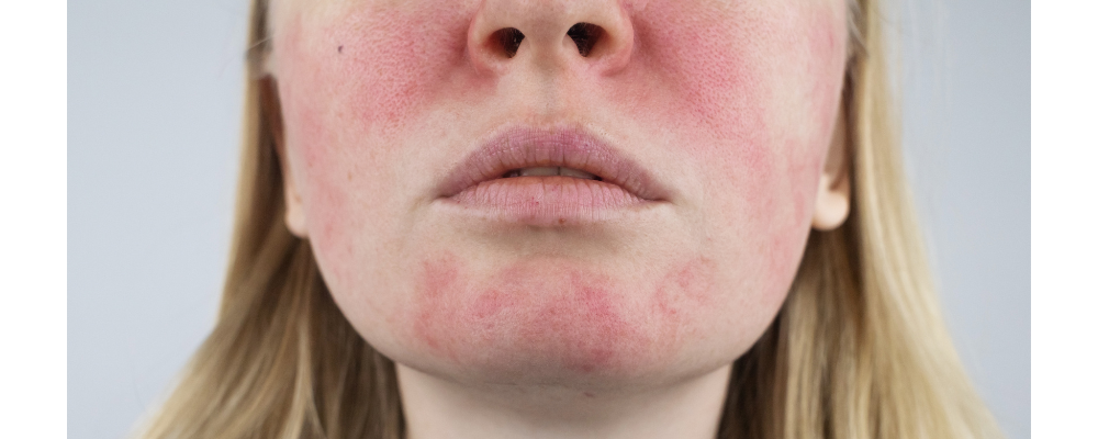 Rosacea