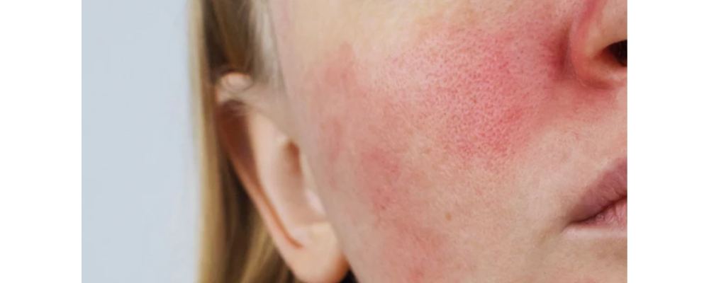 Rosacea